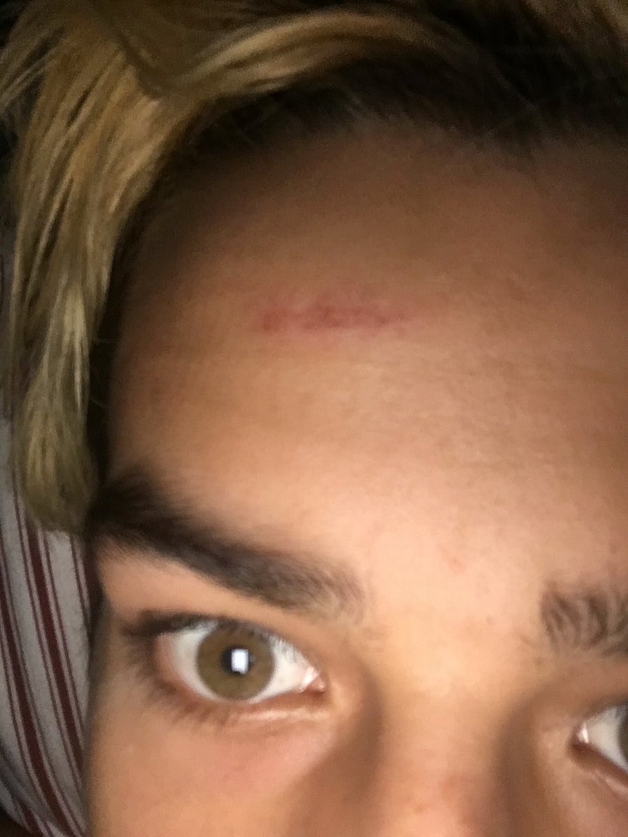 trenton_vargas's tweet photo. I slammed my head against the stage last night ...oops #headbangerproblems https://t.co/g13b63hNOQ