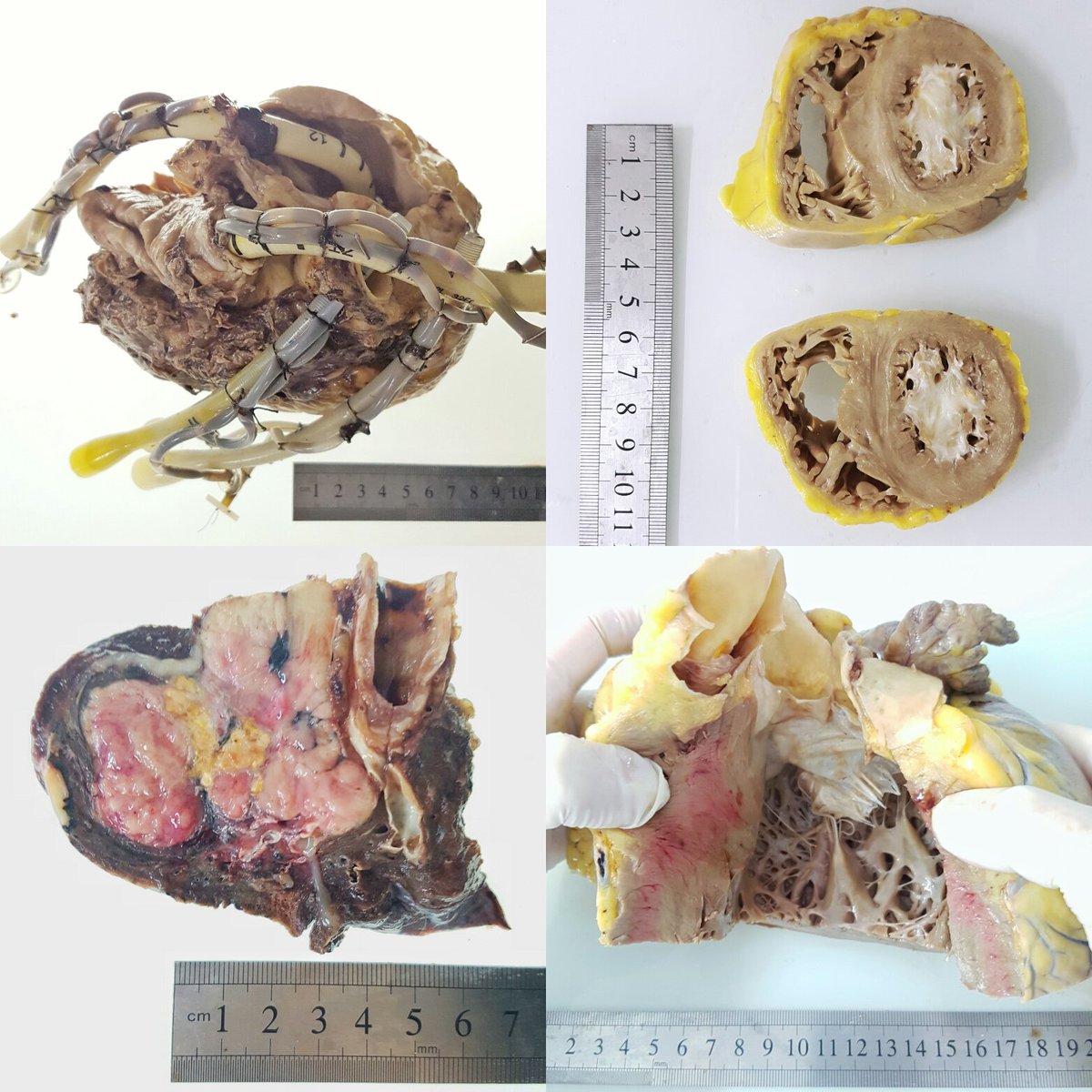 fabiotavora's tweet image. A day at the gross station is always fun #cardiacpath #pulmonarypath #thoracicpath #chagas #noncompaction #lungcancer @ArgosPatologia
