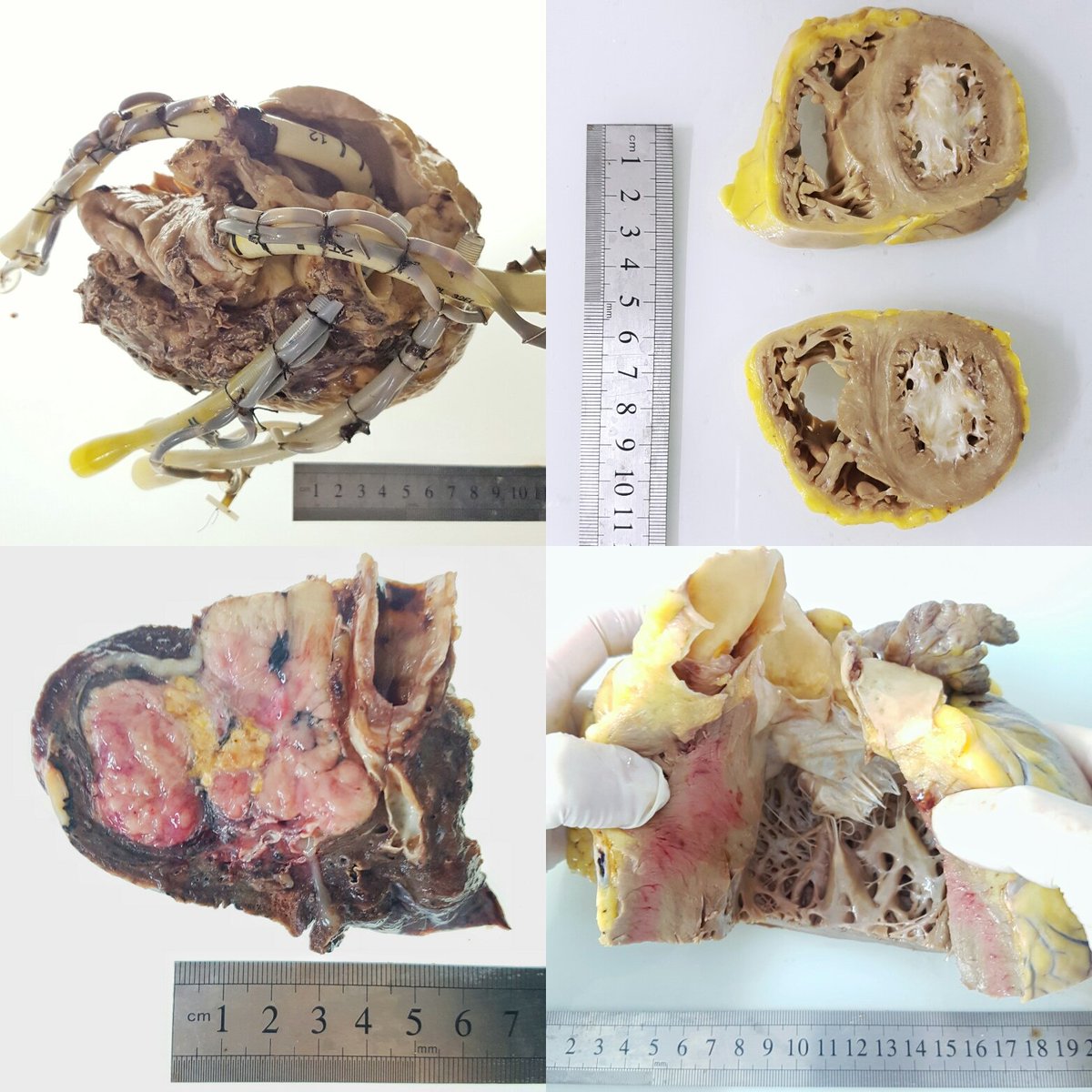 A day at the gross station is always fun #cardiacpath #pulmonarypath #thoracicpath #chagas #noncompaction #lungcancer @ArgosPatologia