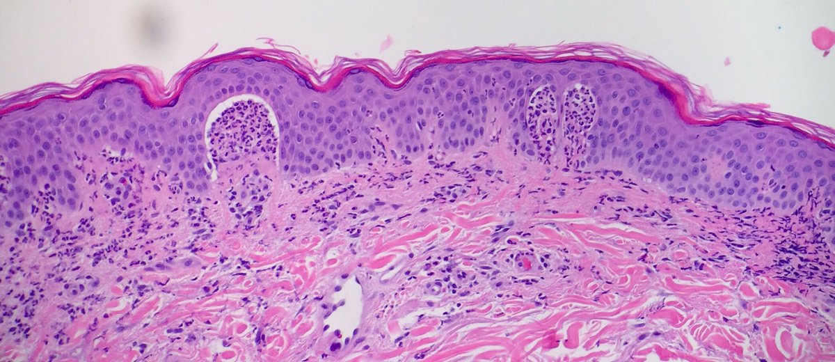 JRamirezMD's tweet photo. Dermatitis herpetiformis: itchy bumps; microabcesses in dermal papillae + gran IgA deposits on DIF #dermpath #pathology #dermatology https://t.co/pwO7CdC73I