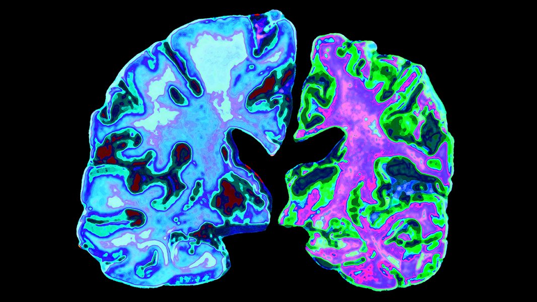 Nature's tweet photo. Failure of Alzheimer’s drug seized upon by ‘amyloid hypothesis’ critics https://t.co/bK2ryNU8KS #Solanezumab https://t.co/InW2WA7iQa