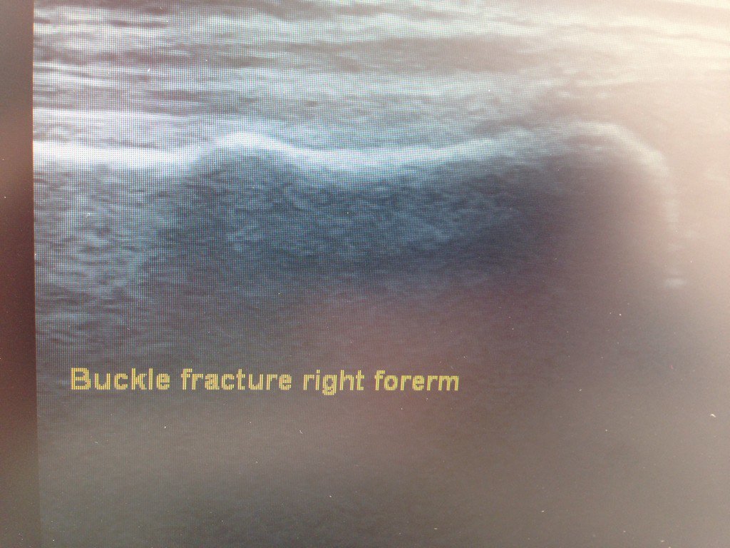 injectiondoc's tweet photo. Pitch side care at its best. Immediate diagnosis of green stick fracture. #sportsinjuries #fracture #rugbydubai https://t.co/aZlbjulrmi