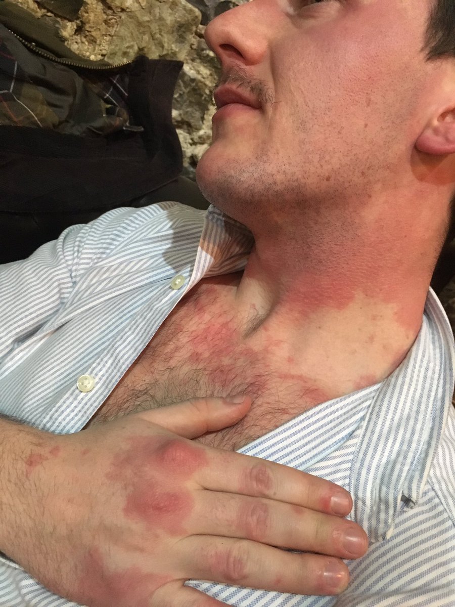 EmiiiilyWebb's tweet photo. Why does my boyfriend get red patches after drinking ? @DoctorChristian https://t.co/rQwUArfMpz