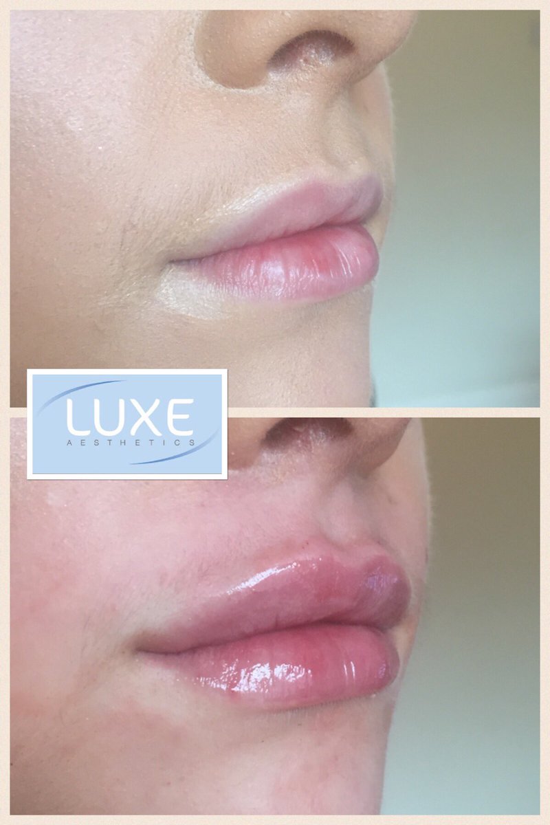 luxeaesthetics's tweet photo. Natural subtle lip enhancement @luxeaesthetics #pout #lips #lipfiller #fullerlips #juvederm #lipenhancement #luxeaesthetics https://t.co/yxzdIg5CIw