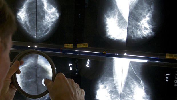 jcragostini's tweet photo. El diagnóstico del #cancerdemama en etapas tempranas, es decisivo para aumentar las posibilidades de sobrevida! https://t.co/FCvMsgmvM3