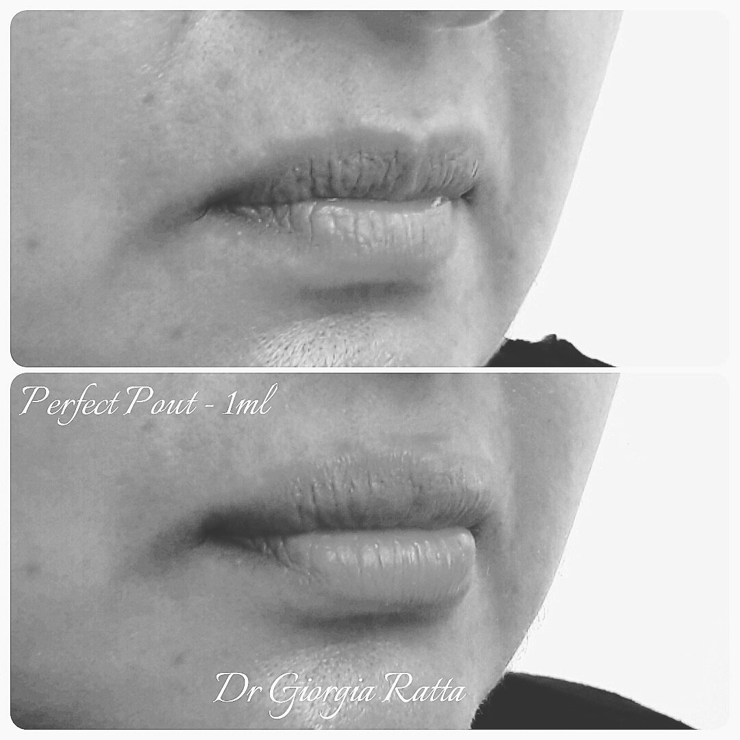 drGiorgiaRatta's tweet photo. When you think "lip filler" rest reassured you won't get a Trout finish with us!#naturallook #perfecthapout #partylip https://t.co/QWWePlYNl8
