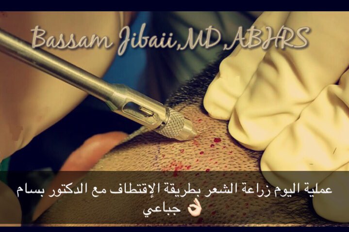 زراعة الشعر بالرياض tweet media