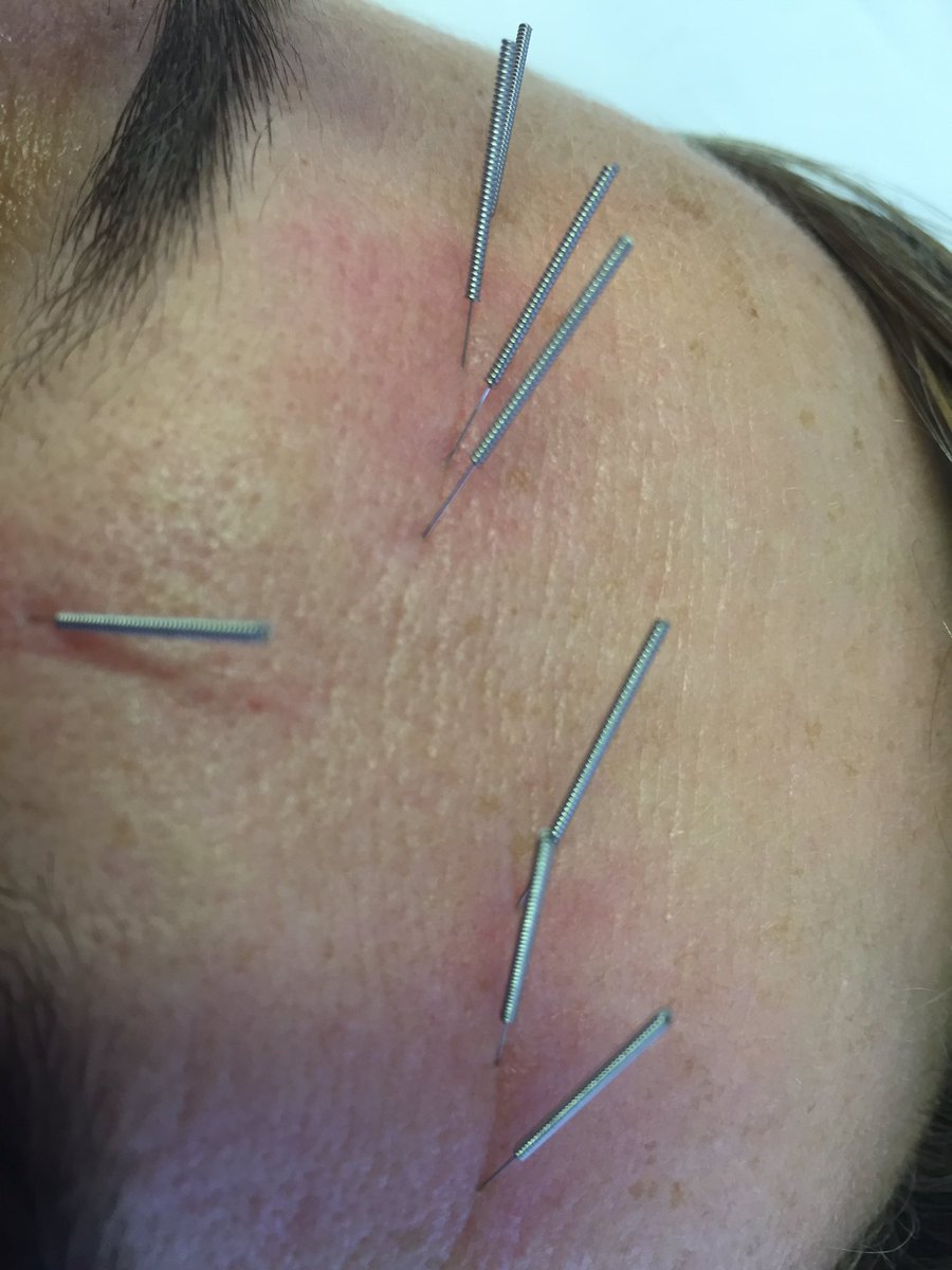 WilsonBleasdale's tweet image. .wow amazing erythema with #cosmetic #acupuncture - THIS is what getting and maintaining a #healthy #complexion is all about