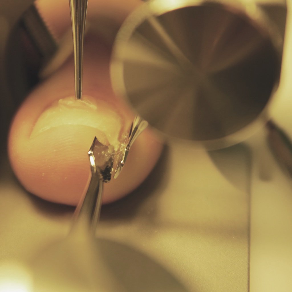 Painful #toenail? Don’t wait any longer, call us at (01) 490 7178 and treat your #ingrownnails ! #theworkssalon #noninvasive #podology