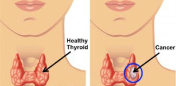 bharatstories's tweet photo. Thyroid Cancer: Causes, Symptoms & Treatment
#thyroidcancer #thyroidcauses #healthtips #healthcare #indiangk
https://t.co/EzT0pPx3u4 https://t.co/QauvicNBSc