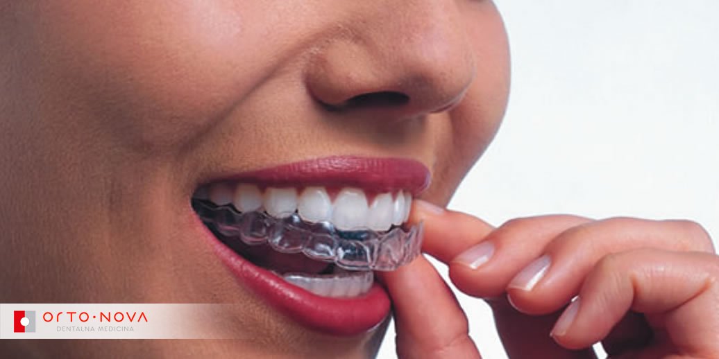 Invisalign - ispravlja zube na potpuno neprimjetan način! Provjerite više na: goo.gl/tA50xq ;) #Dentist #invisalign