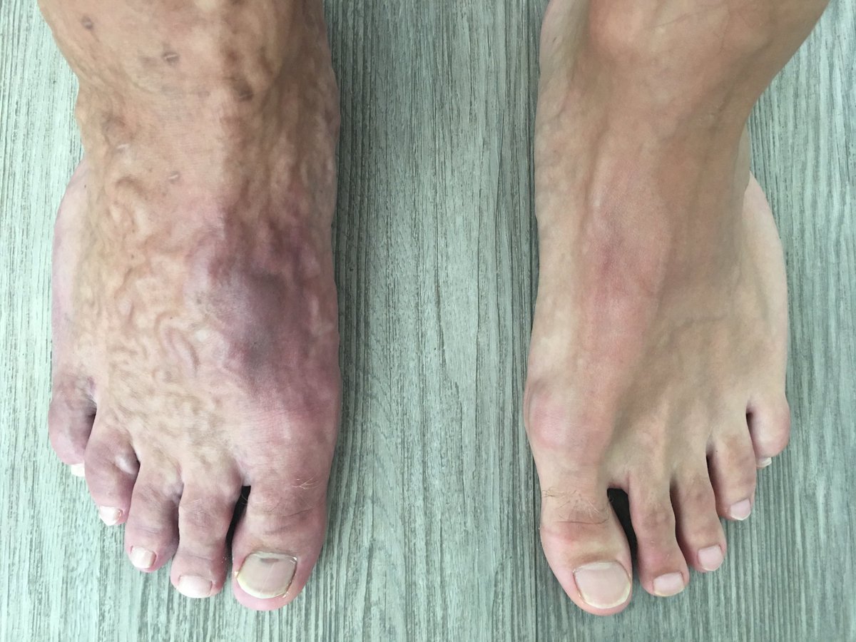 ZickermanAnna's tweet photo. Interesting feet @UPANDRUNNINGdxb #varicoseveins #swollenfeet #vessels #athlete #circulation #cyanosis https://t.co/qgf2citSDL