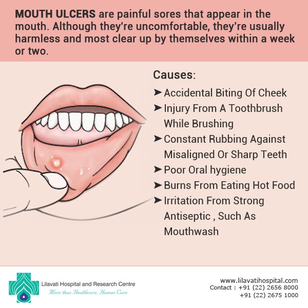 Wings Pharma And What Better Solution For Pain Relief From Mouthulcers Than Orasore Mouth Ulcer Relief Gel T Co G4xaeq0ddb Twitter Wings Pharma And What Better Solution For Pain Relief From Mouthulcers Than Orasore Mouth Ulcer Relief Gel T Co G4xaeq0ddb Twitter