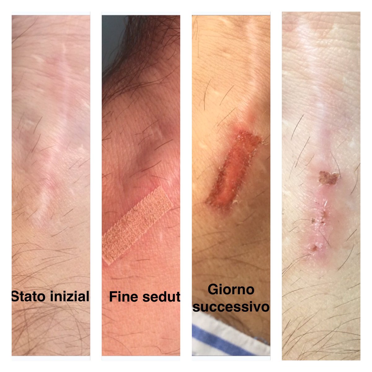 Rimozione cicatrici con laser frazionato
