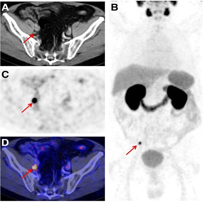 PSMA targeting #imaging provides a #prostate #cancer specific target that may provide better sensitivity #UCLAUrology #UCLAMDCHAT