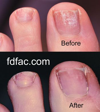 InstantShoeLock's tweet image. Not All Toenail Fungus Is Created Equal buff.ly/2fIbDZ6