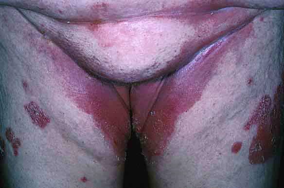 SimonovKassi's tweet photo. It Is Now Recognized That This Doesn’t Have To Be Sexually Transmitted As Anyone Can Get A https://t.co/kIY4ncJDQW https://t.co/MIccIJUdp7