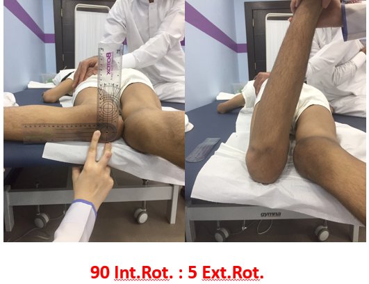 DrEhabWalyEG's tweet photo. Not used to see #femoral #anteversion like that. #CerebralPalsy #spastic https://t.co/5CaWiKRWle