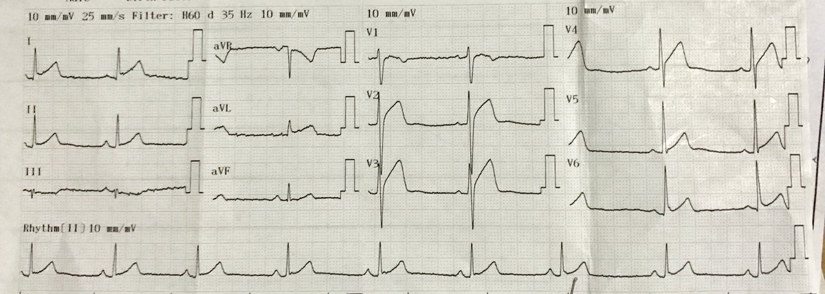 umanamd's tweet image. Every time I get a ~30 y/o pt w/ a STEMI, can’t help but think about the changes we need to do to have a longstanding life in EM
#codeSTEMI