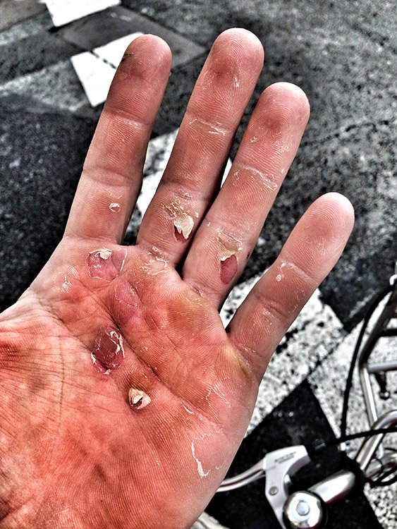 NatRowingFound's tweet photo. Remember this article? Still great tips for rowers struggling with hand blisters. #RowingTips #RowerProblems #TBT https://t.co/RqL6VkYkJg https://t.co/daJ1sU2mrP