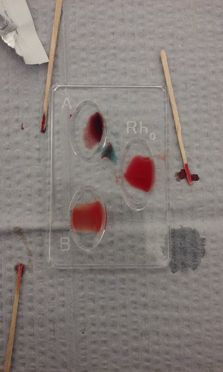joan_elfie's tweet photo. I'm possitively A (A+). #bloodtyping #Bio110Fall16 @NutmegSomething https://t.co/LB5I3En1eN