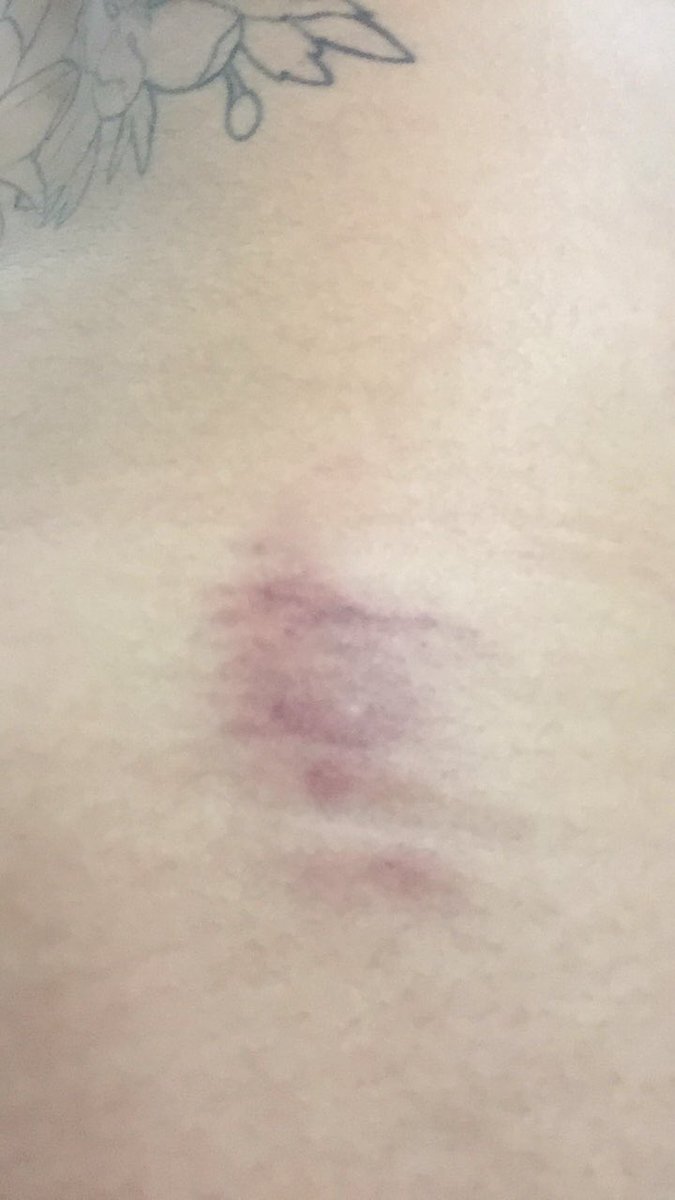 daybttCW's tweet photo. Resultado de uma intra venosa e uma intra muscular 👌🏻 https://t.co/cZCwPfUftP