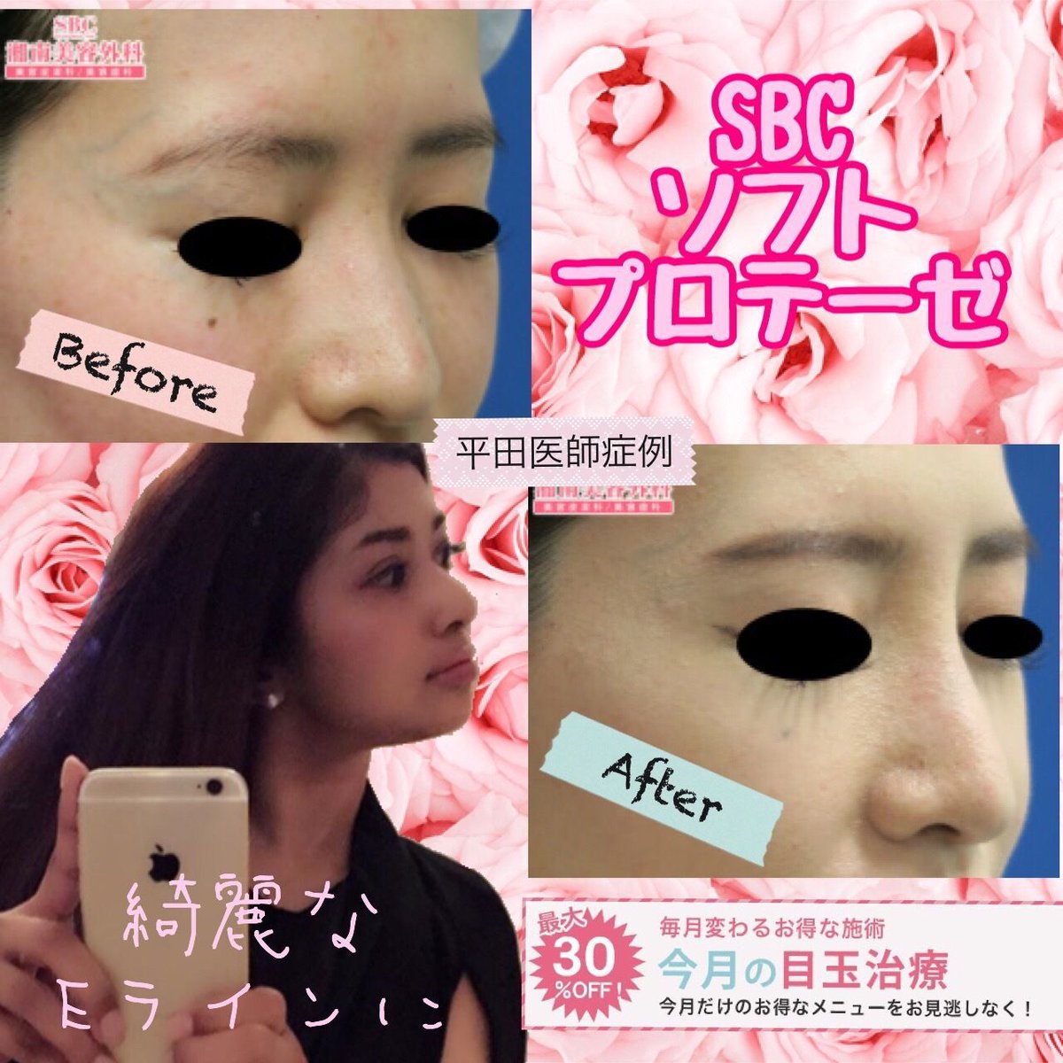 湘南美容クリニック 池袋東口院 Twitterren 一生ものの高い鼻を今月なら 118 000 プロテーゼな自然にスッキリした鼻になります 鼻ぺちゃで悩んでる人は是非 当日施術可 もっとお得なモニター T Co Dn36oweant ご予約 01 742 910 湘南美容外科 鼻