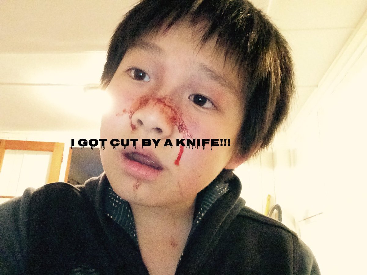 NEXTBOY027's tweet photo. Got cut by knife... https://t.co/n6cfokAkp0
