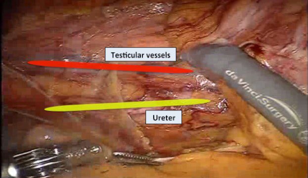 NdeA81's tweet photo. Robotic right colectomy surgical steps for trainees @giobi_87 @jaginpdx @robotic        https://t.co/xAZKQcPj28 https://t.co/VFJ67Tzmcr