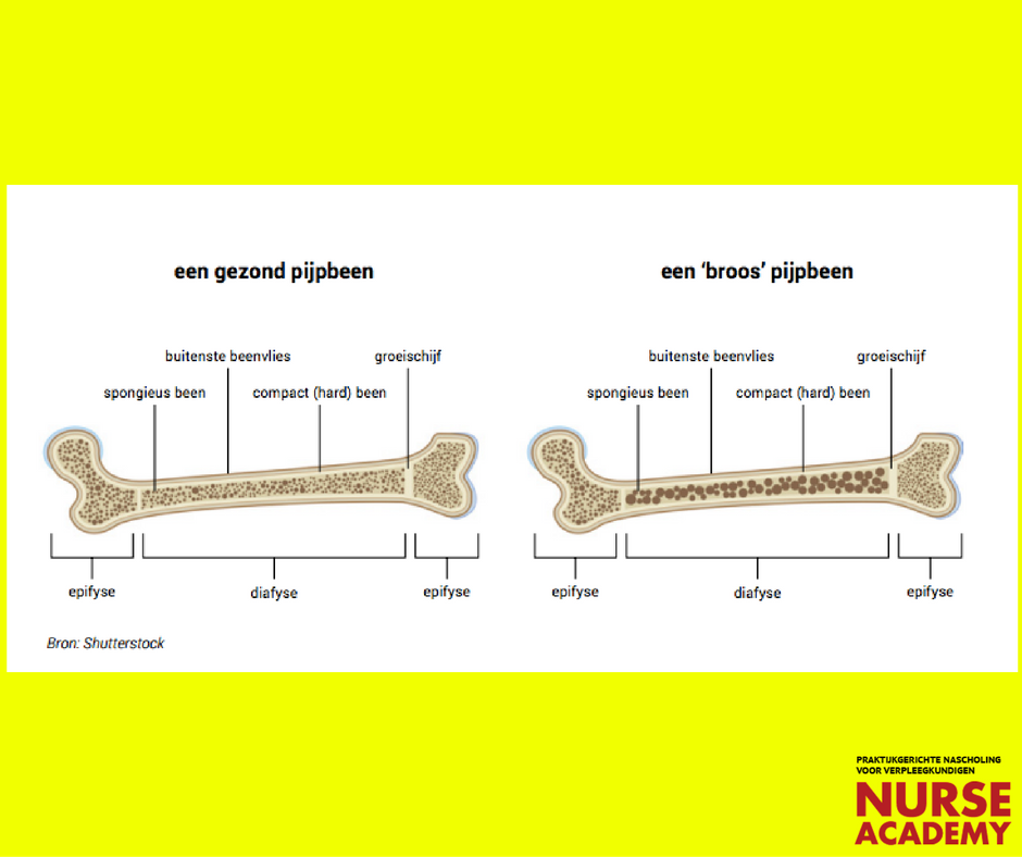 NurseAcademy's tweet photo. Zie hier het verschil tussen een gezond- en een broos pijpbeen. https://t.co/PnejUGL1x3
