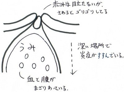 紫ニキビの対処
広範囲で膨らみ、触るとゴリゴリします
真皮層まで進行すると確実に痕が残るニキビです
深くの膿は身体に吸収・排泄されますが、血流が悪い事で遅延しています
・血流悪化に繋がる冷えを予防
・表情筋トレーニングで血流UP… 