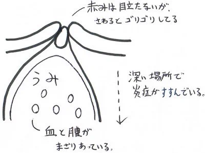 紫ニキビの対処広範囲で膨らみ、触るとゴリゴリします真皮層まで進行すると確実に痕が残るニキビです深くの膿は身体に吸収・排泄されますが、血流が悪い事で遅延しています・血流悪化に繋がる冷えを予防・表情筋トレーニングで血流UP… 