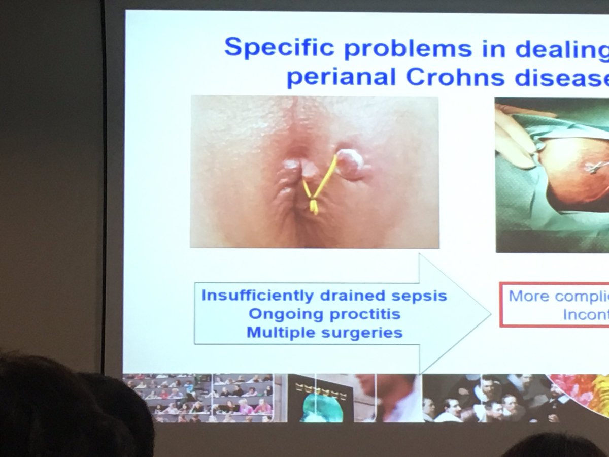 manu_barreiro's tweet photo. Dr Bemelman exponiendo las opciones quirúrgicas en el Crohn perianal #MAG2016 https://t.co/1kwvQ70JXX