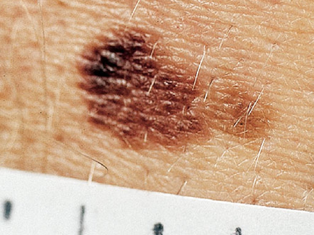 A mole is suspicious if the diameter is larger than the eraser of a