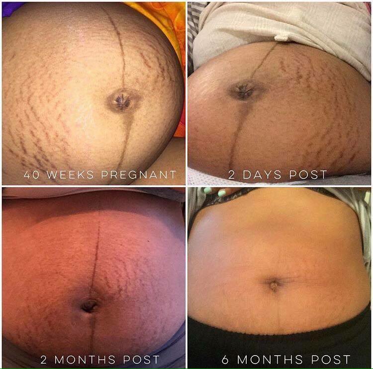 PrincessPWraps's tweet image. Do I have any moms on my timeline that want to get rid of stretch marks ? I need 6 people for my 90 day challenge.....comment below