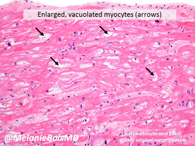 MelanieBoisMD's tweet photo. Hydroxychloroquine cardiotoxicity shows vacuolated myocytes on H&E; EM demonstrates myelinoid & curvilinear bodies #cardiacpath #MayoCVPath https://t.co/aTiHLKeefy