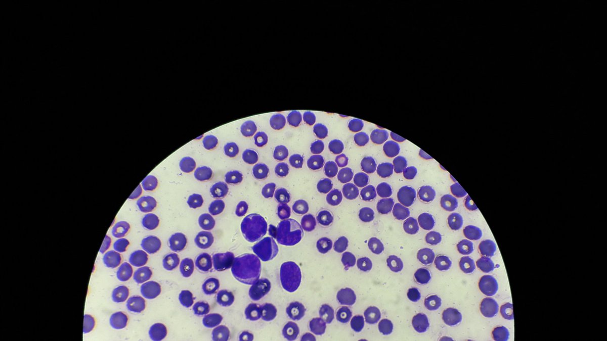 MedTechProblems's tweet image. Pati WBC, pinusuan ko na. 
#labdiaries

-ri💕