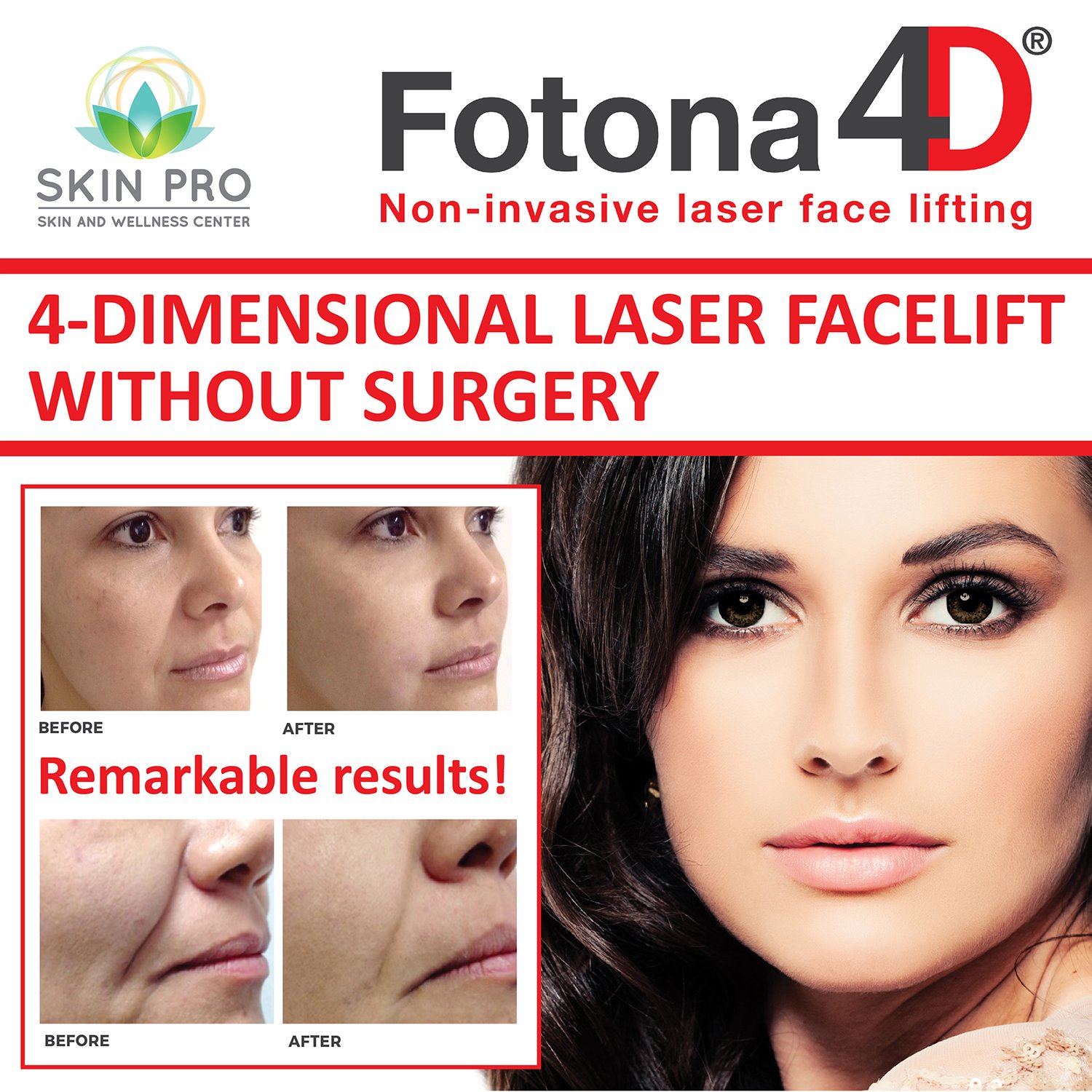 Skin Pro Ph On Twitter Fotona4d Laser Facelift Without Surgery Skinproph Fotona Nightlase Fotona4d Facelift Beauty Skin Skincare Skin Pro Ph On Twitter Fotona4d Laser Facelift Without Surgery Skinproph Fotona Nightlase Fotona4d Facelift Beauty Skin Skincare