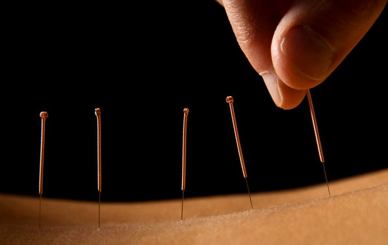 qa_ivf's tweet photo. Does Acupuncture Work for Infertility: https://t.co/KNf2oG5vz0
#acupuncture #fertility #infertility #ivf #infertilitytreatment https://t.co/6gGf0Lmlcj