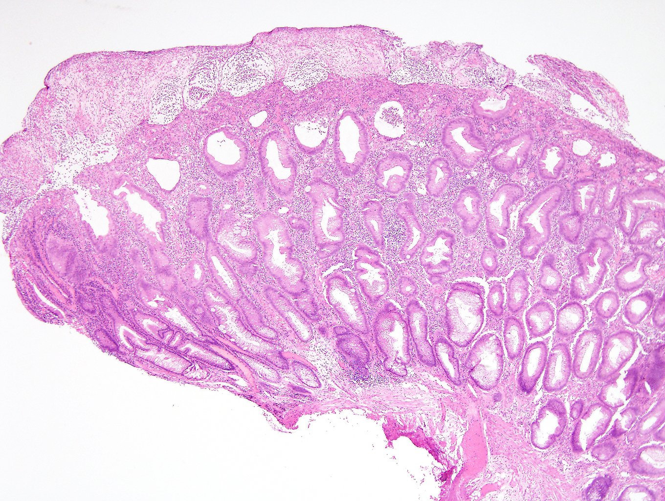 ARP Press on Twitter "Cap polyposis. Learn more of Facebook search