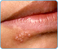 SisquocHC's tweet photo. What should you do ???
When Are Herpes Outbreaks The Most Contagious???
https://t.co/JDvJpLwzlO
#dialine #herpes #contagious https://t.co/rLML0wFuBN