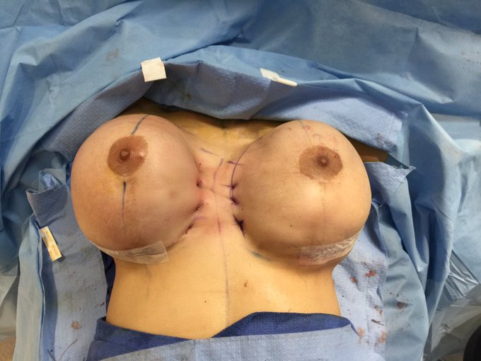 Graphic pic,but am so happy I reached my goal after years of suffering.Just wanted to share https://t