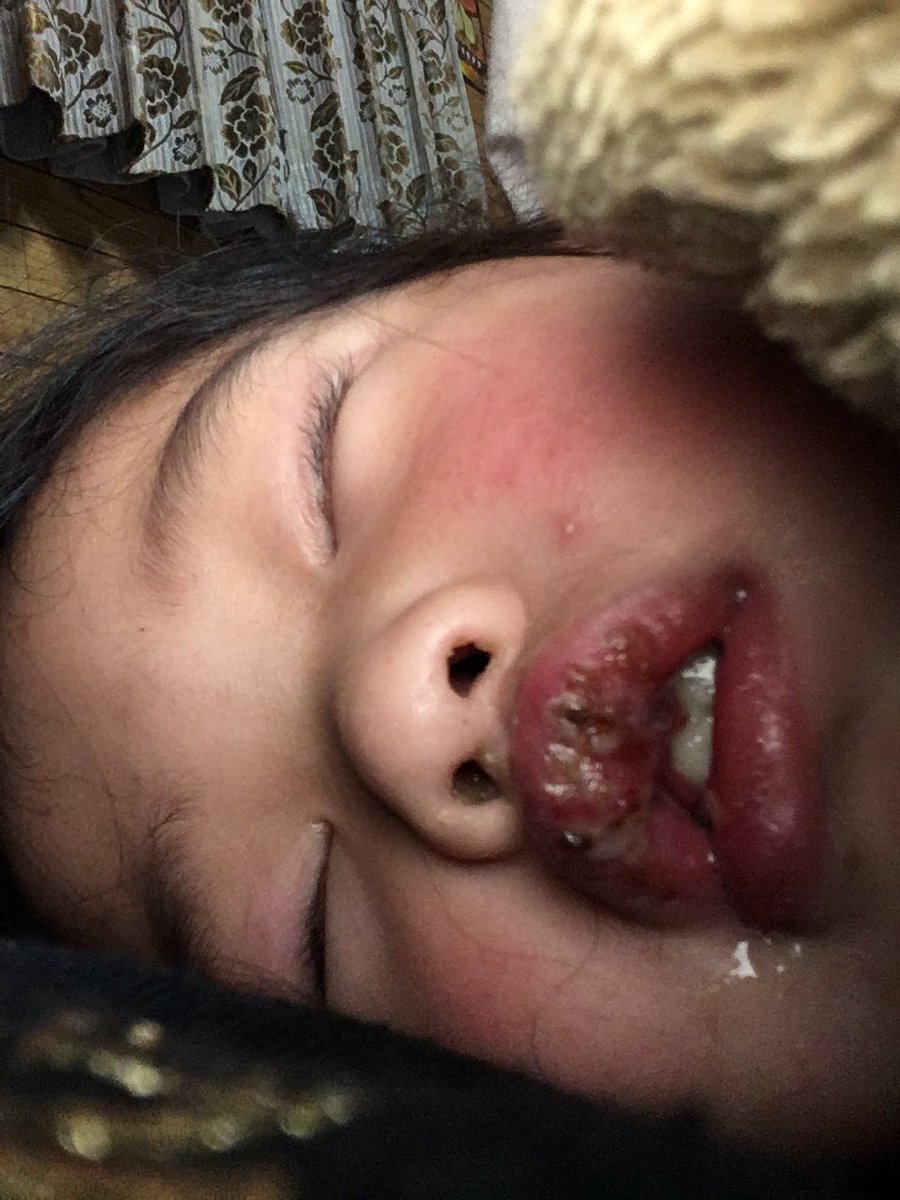 chipoooopo's tweet photo. 今から入院😭😭😭
口もろ痛そう
はやくよくなってね https://t.co/MGUnvEISkW