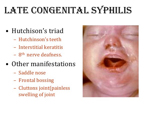 saddle nose syphilis baby