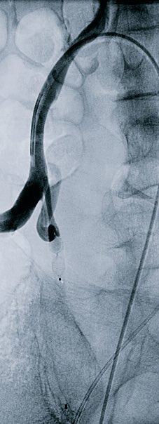 Renal AVM causing a varicocele and Dyspnea- embo X 2
1. AVM-AVP &amp;coils
2. varicocele- STS&amp;AVP
-dyspnea resolved on the table #irad <a href="/SIRRFS/">SIR RFS</a>