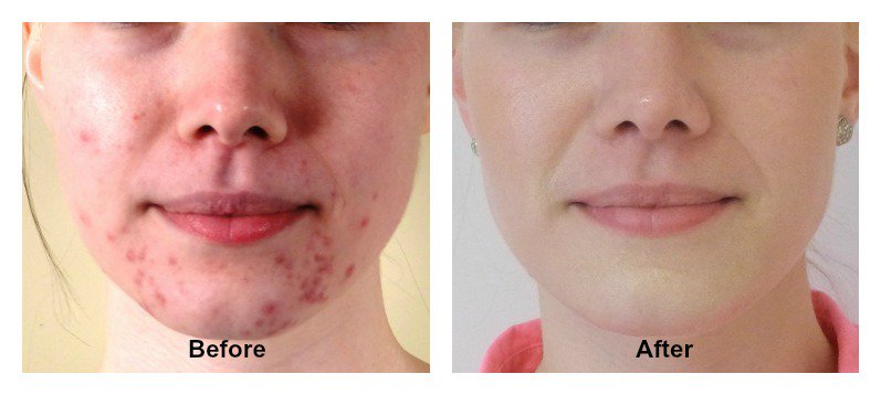 MiracleFaceMed's tweet photo. #MiracleFaceMedSpa is offering new, successful approach to #acne treatment! #LightPod Neo is an effective #treatment for acne! #midtown #nyc https://t.co/ujE7FogYLx