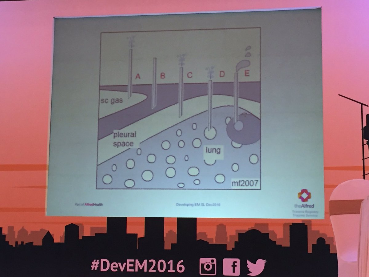trainthetrainer's tweet photo. #DevEM2016 Mathew: "finger thoracostomy" for suspected tension pneumothorax in trauma. Needle decompression fails in 1/3 and can do damage. https://t.co/cvvg2mxsB6
