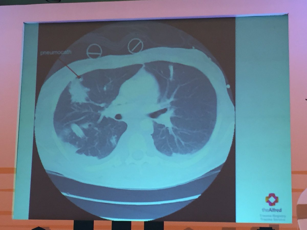 trainthetrainer's tweet photo. #DevEM2016 Mathew: "finger thoracostomy" for suspected tension pneumothorax in trauma. Needle decompression fails in 1/3 and can do damage. https://t.co/cvvg2mxsB6