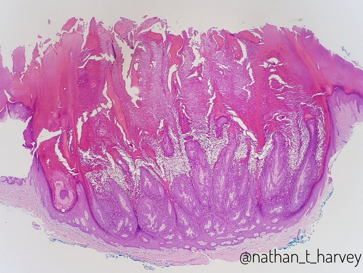 Plantar Wart Histology