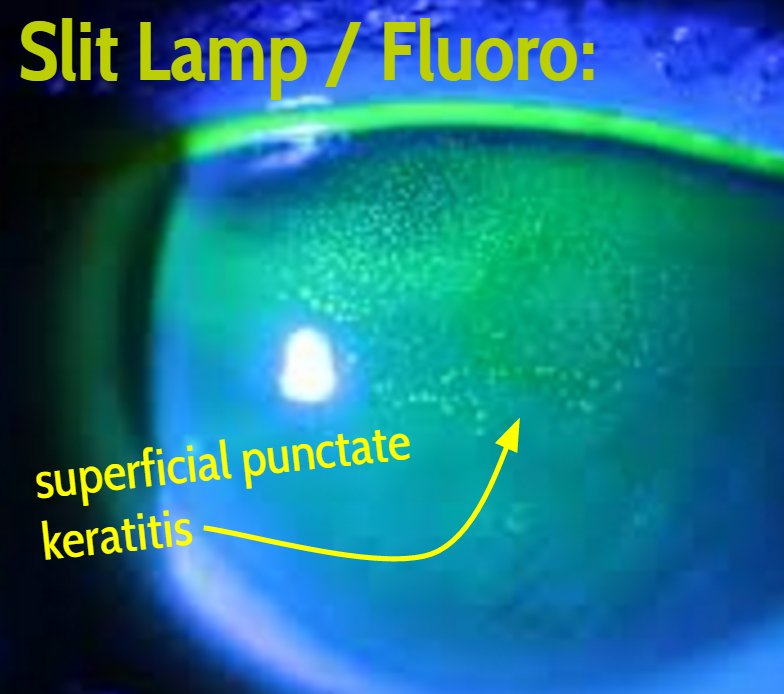 Superficial Punctate Keratitis
